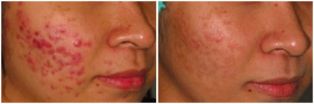 Photodynamic-therapy-1-before-after