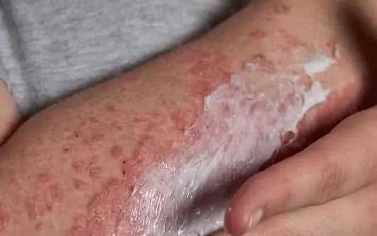 Applying-moisturizer-to-skin-with-psoriasis