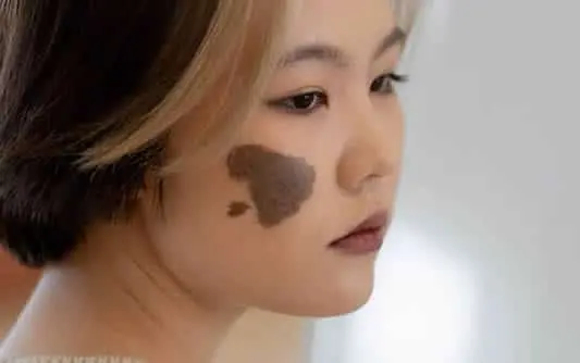 Woman-with-Birthmark-on-Her-Face